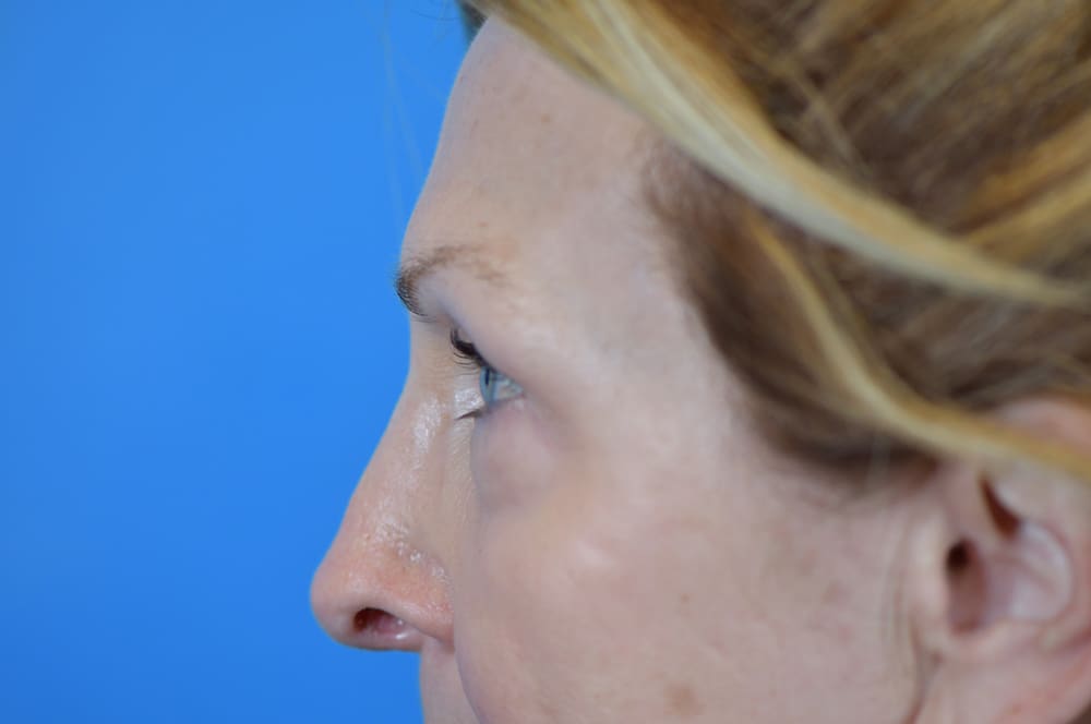 Blepharoplasty Before and After Pictures Indianapolis, IN