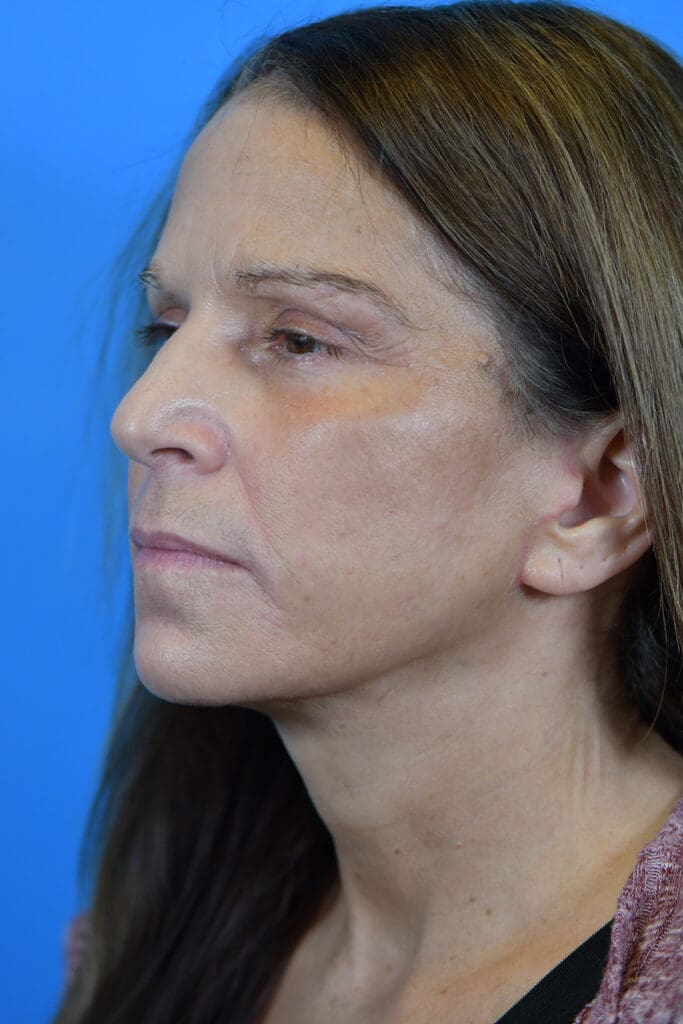 Facelift Before and After Pictures Indianapolis, IN