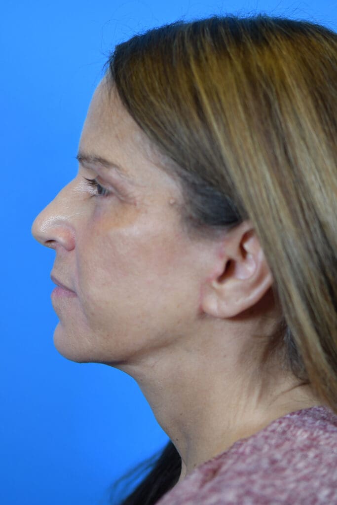 Facelift Before and After Pictures Indianapolis, IN