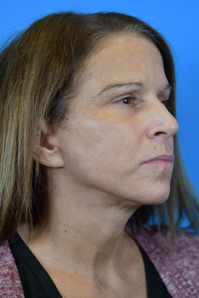 Facelift Before and After Pictures Indianapolis, IN