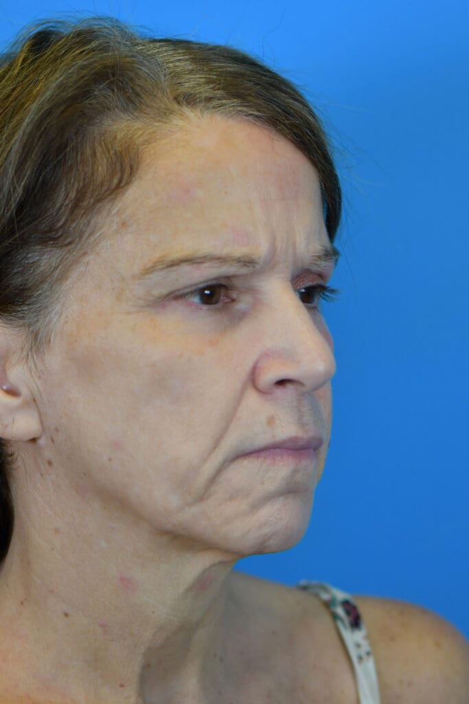 Facelift Before and After Pictures Indianapolis, IN