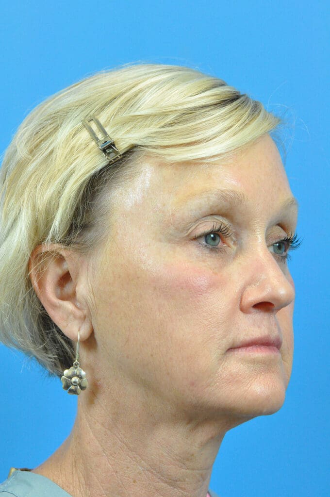 Facelift Before and After Pictures Indianapolis, IN