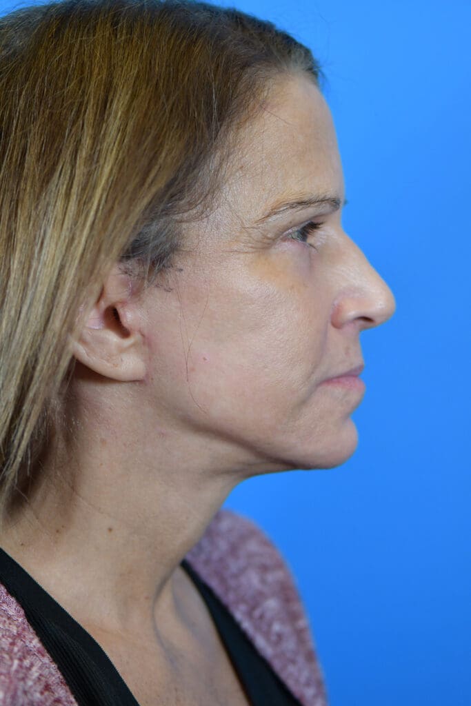 Facelift Before and After Pictures Indianapolis, IN