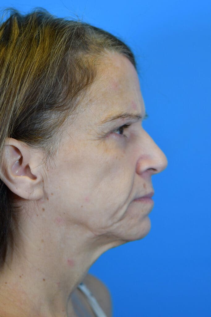 Facelift Before and After Pictures Indianapolis, IN