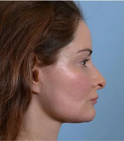 facelift-a-1