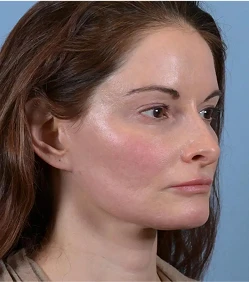 facelift-a-2
