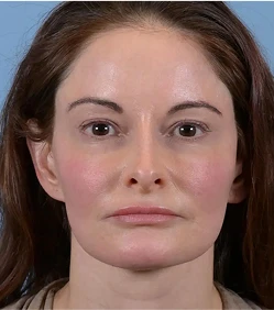facelift-a-4