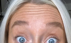 botox1