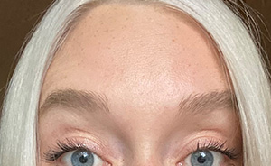 botox2