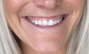 botox3