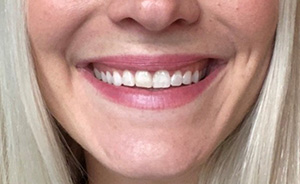 botox4
