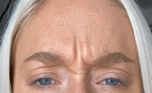 botox5
