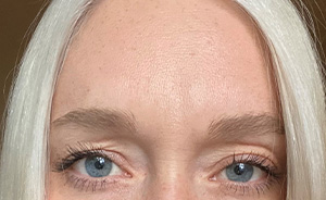 botox6
