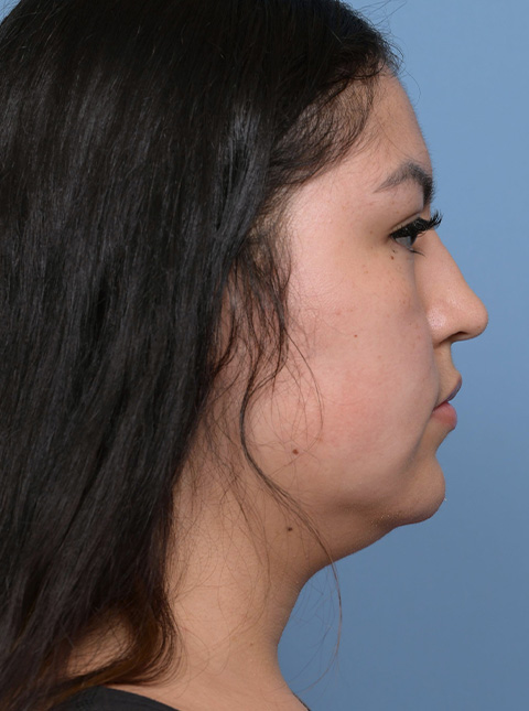 buccal1