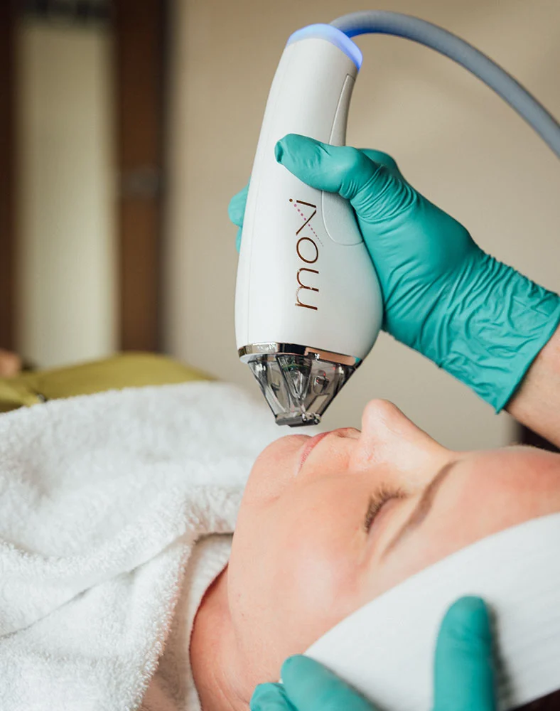 Close-up of a woman receiving a facial treatment with a white handheld device labeled "Now." The device, held by a person wearing teal medical gloves, is positioned near the woman's face as she lies on a light beige surface covered with a white towel. Her eyes are closed, and she appears calm and relaxed. - Laser Skin Rejuvenation Moxi Microlaser in Carmel, IN