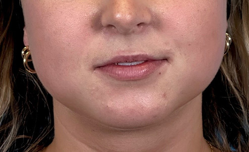 lip1