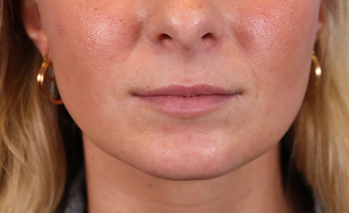 lip21