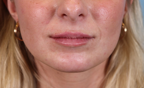 lip22