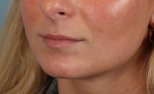 lip23