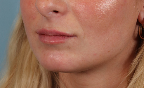 lip24