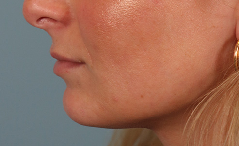 lip25