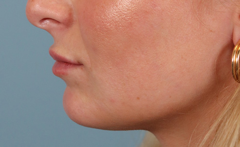 lip26