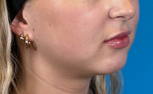 lip4