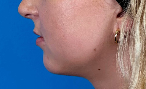 lip5