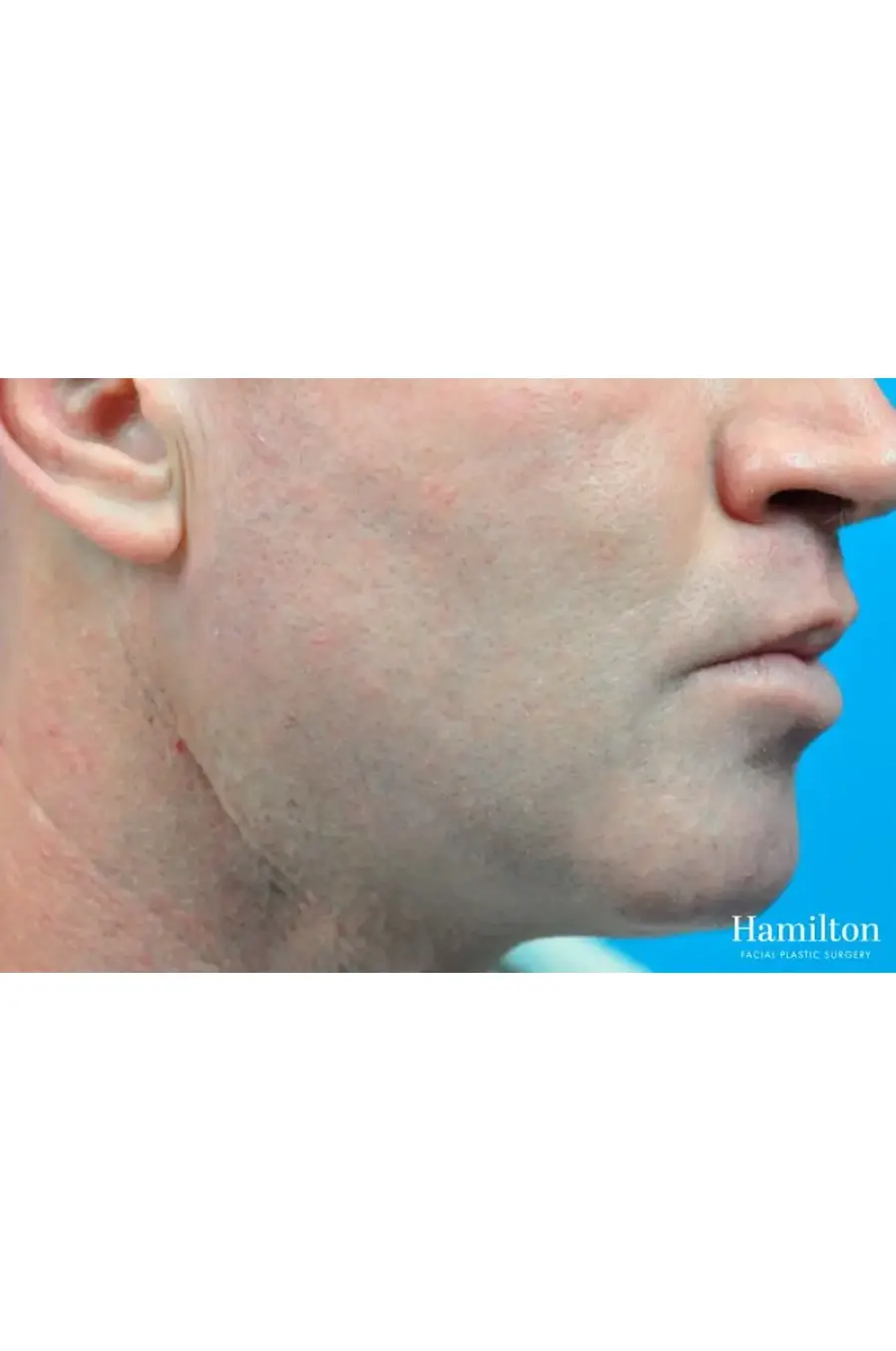 fractional-resurfacing-after-03