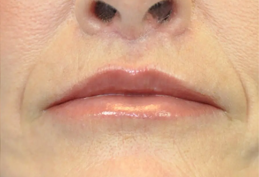 surgical-lip-enhancement-before-and-after-7U3rtM6TAS4R_highres.webp