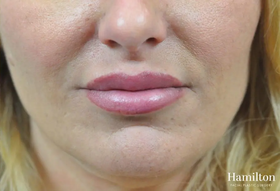 surgical-lip-enhancement-before-and-after-W07O7547a0h1_highres.webp