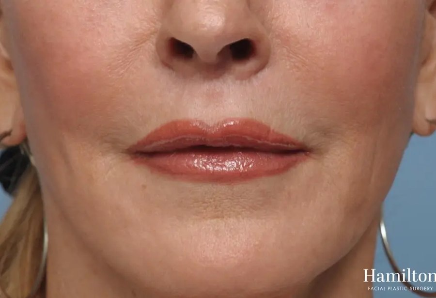 surgical-lip-enhancement-before-and-after-fvf8Tql2P8tu_highres.webp