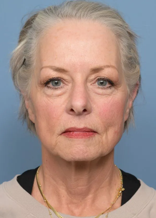 Comprehensive Facial Rejuvenation_p01-01