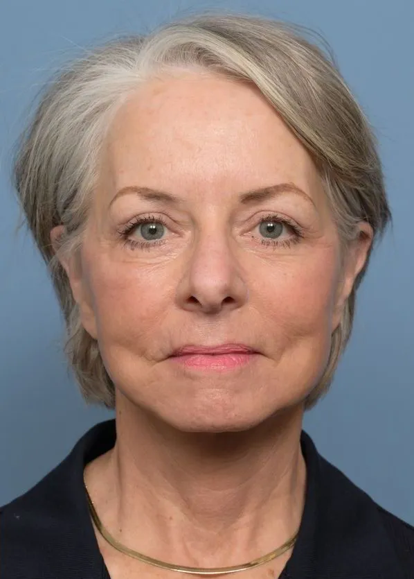 Comprehensive Facial Rejuvenation_p01-02