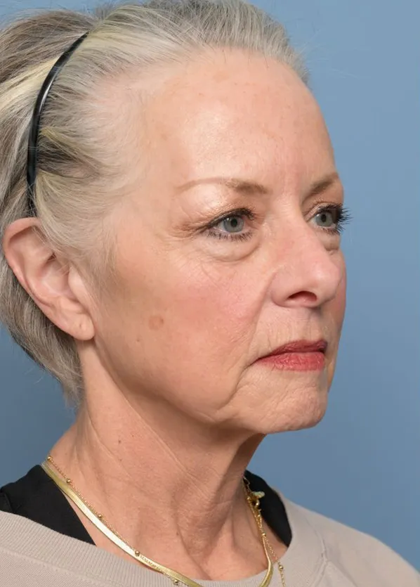 Comprehensive Facial Rejuvenation_p01-03