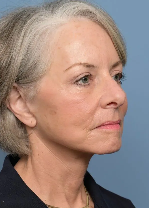 Comprehensive Facial Rejuvenation_p01-04