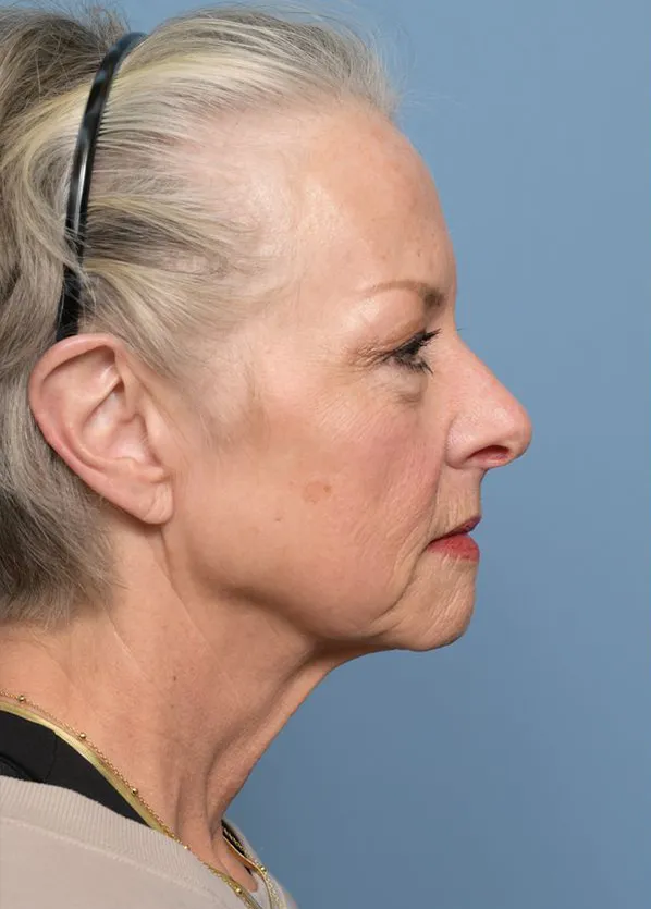 Comprehensive Facial Rejuvenation_p01-05