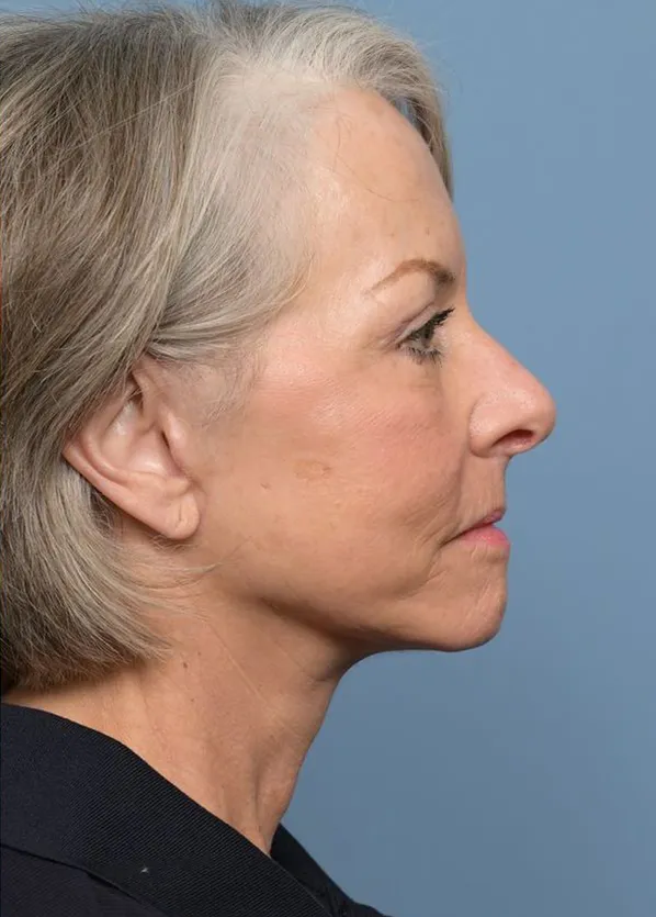 Comprehensive Facial Rejuvenation_p01-06