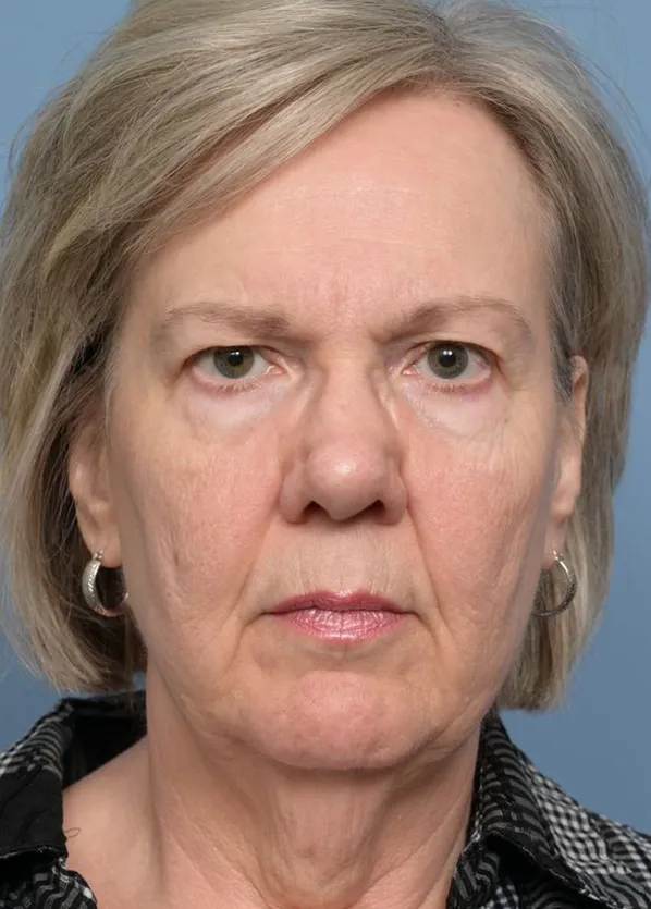 Comprehensive Facial Rejuvenation_p02-01