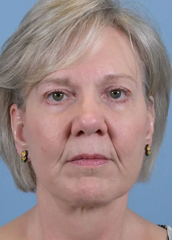 Comprehensive Facial Rejuvenation_p02-02