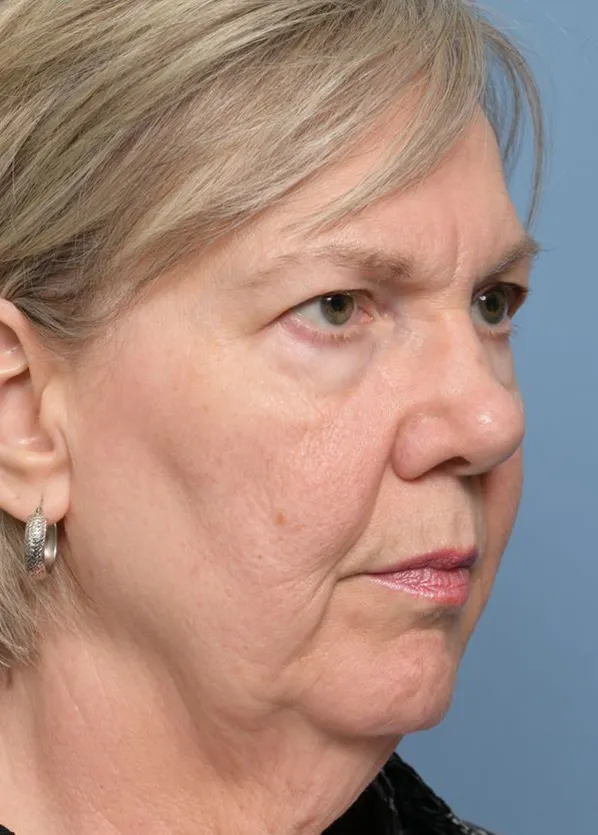 Comprehensive Facial Rejuvenation_p02-03