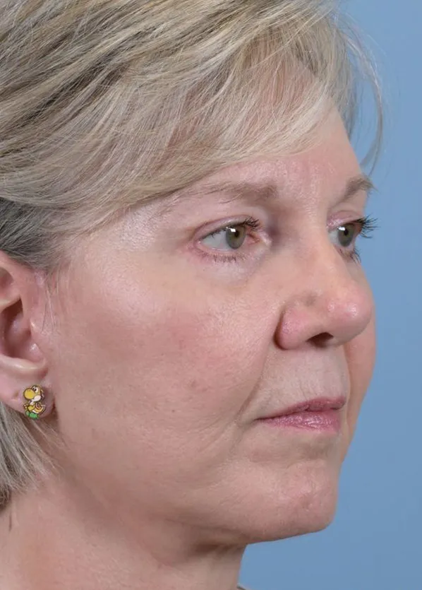 Comprehensive Facial Rejuvenation_p02-04
