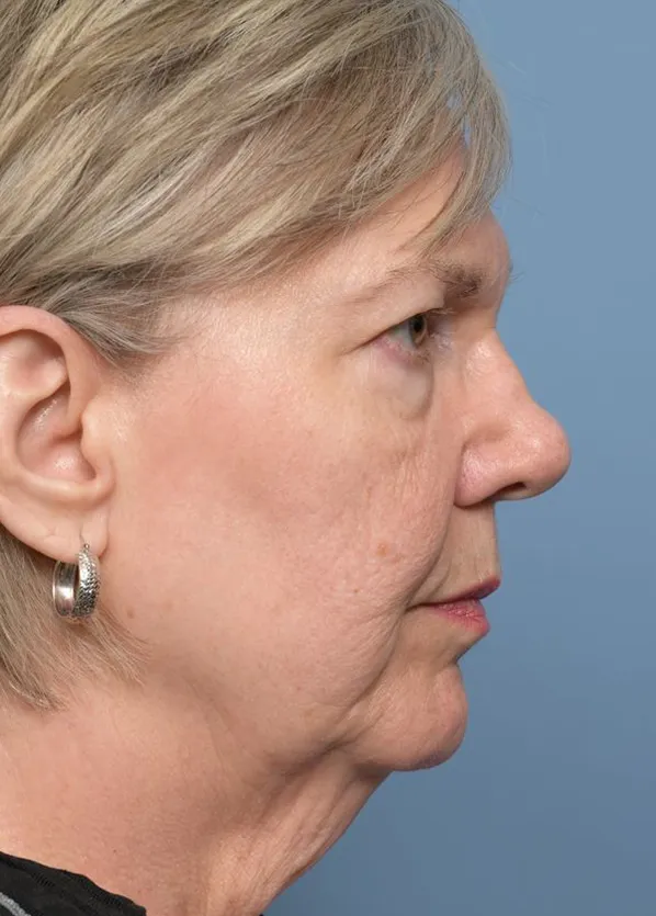 Comprehensive Facial Rejuvenation_p02-05